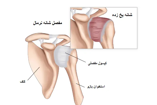 شانه یخ زده و راه های درمان