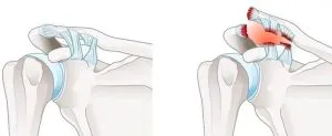 بی ثباتی شانه