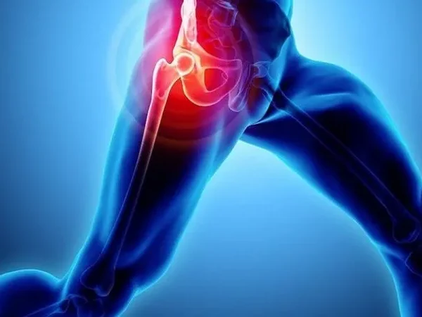 متلازمة قطع الحوض