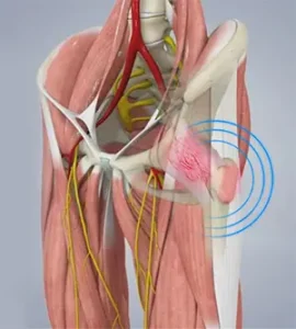 علائم سندرم اسنپینگ لگن