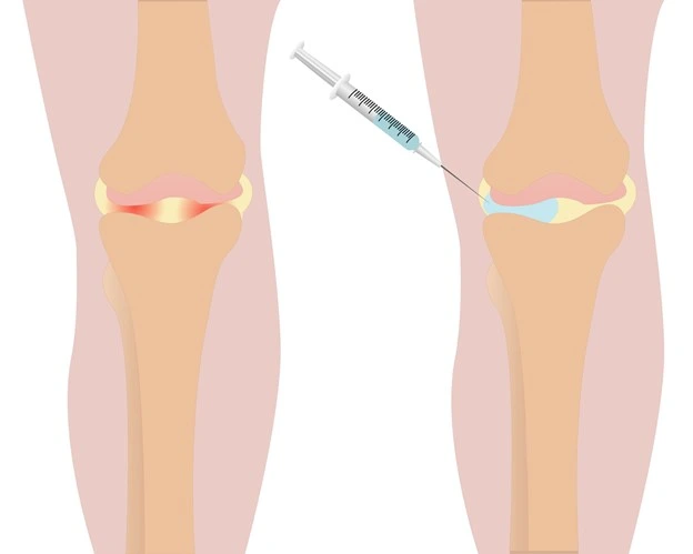 تزریق ژل هیالورونیک اسید