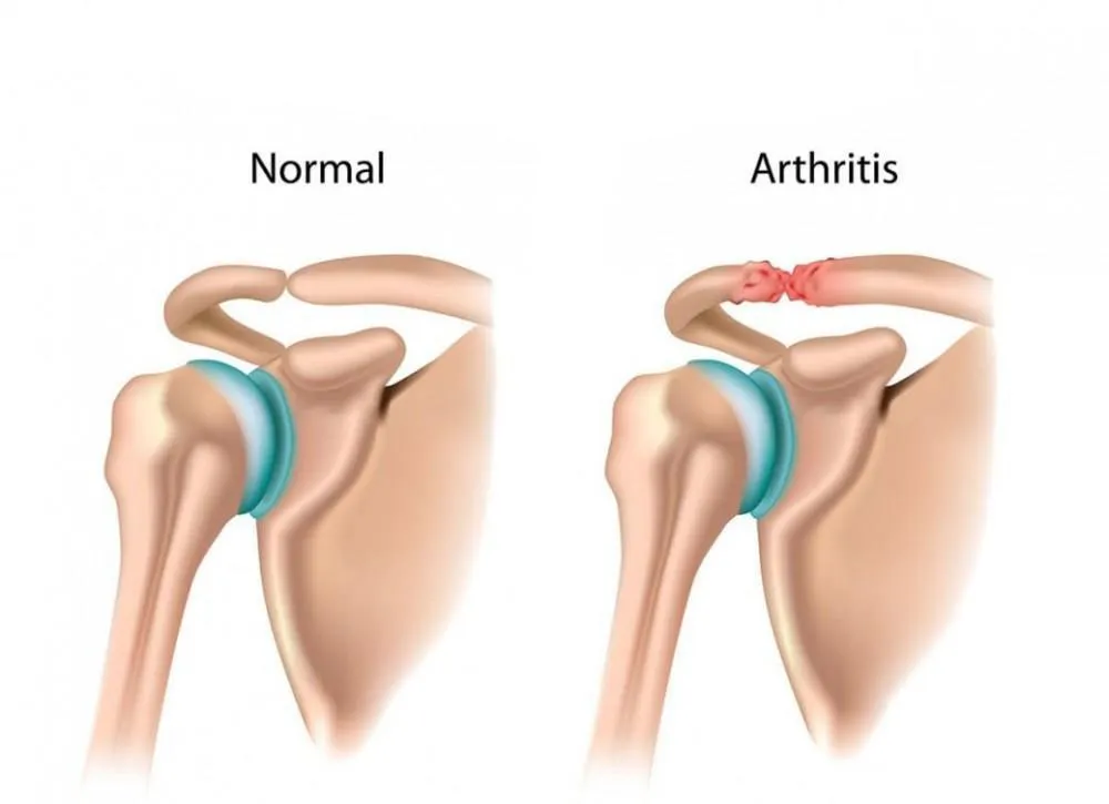 مشکلات مفصل آکرومیوکلاویکولار