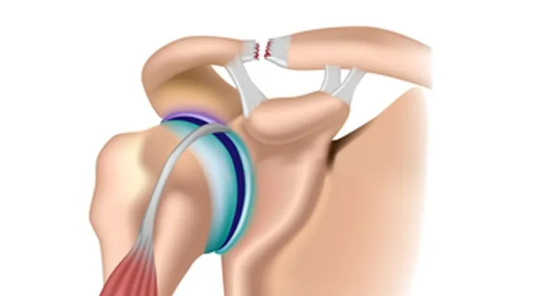 مشکلات مفصل آکرومیوکلاویکولار