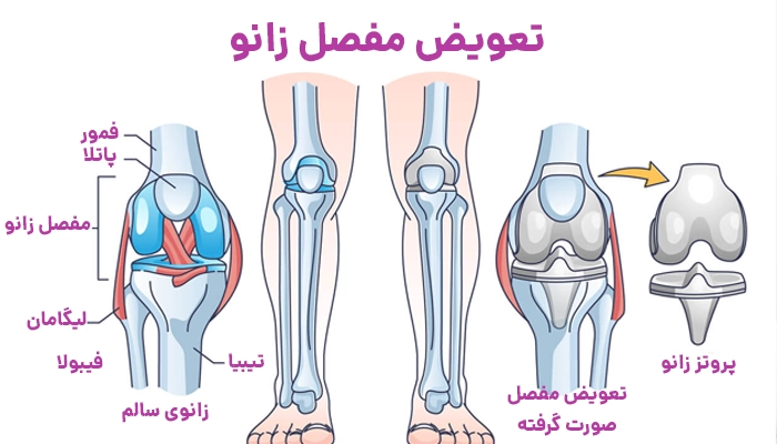 تعویض مفصل زانو و زانوی سالم