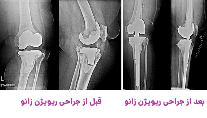 قبل و بعد جراحی ریویژن زانو