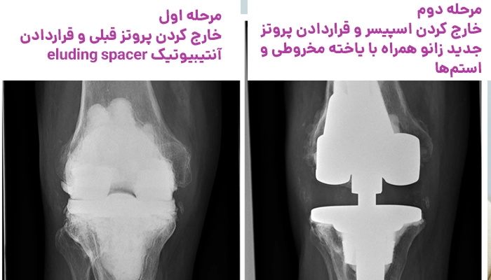 مرحله تعویض مجدد مفصل زانو
