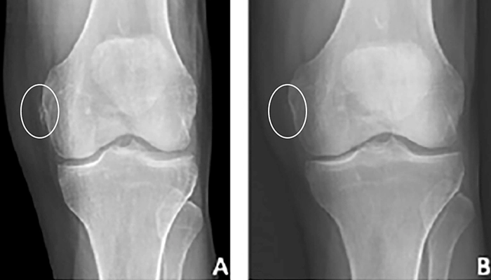 mri  از رباط mcl پاره 