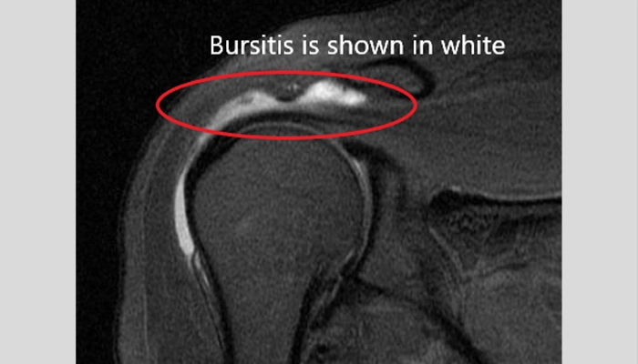 MRI از بورسیت شانه