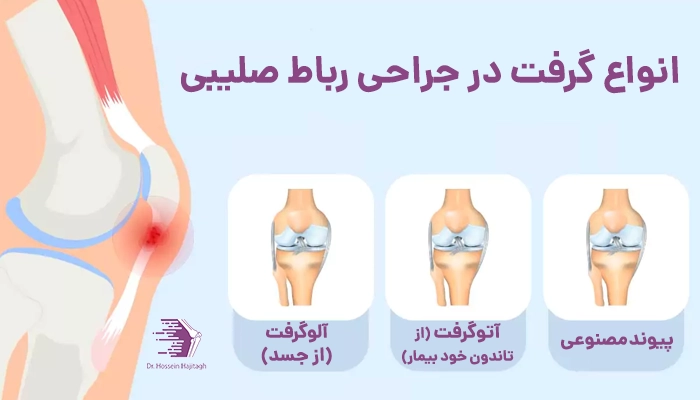 انواع گرفت در جراحی رباط صلیبی