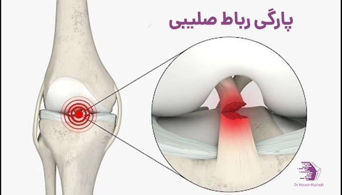 پارگی رباط صلیبی