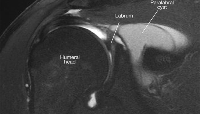 mri لابروم
