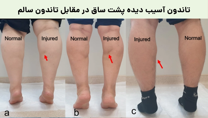 تاندون آسیب دیده پشت ساق در مقابل تاندون سالم 