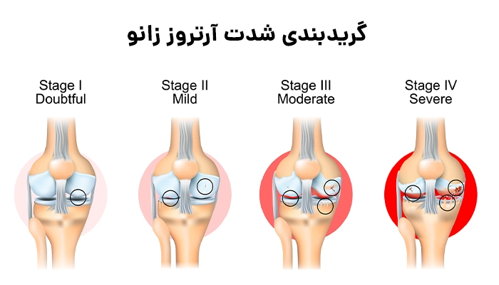 گریدبندی آرتروز زانو
